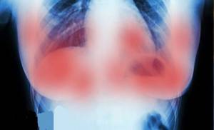 Científicos de Ámsterdam logran destruir tumores de cáncer de mama en 11 días y sin quimioterapia